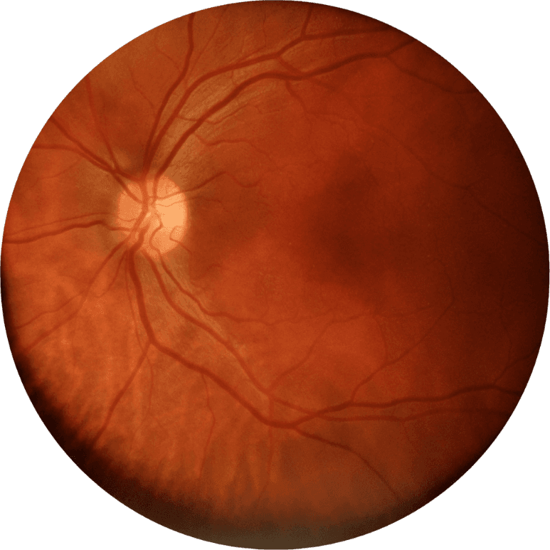 Atendimento especializado em glaucoma